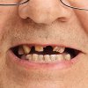 adult-missing-teeth-300.jpg