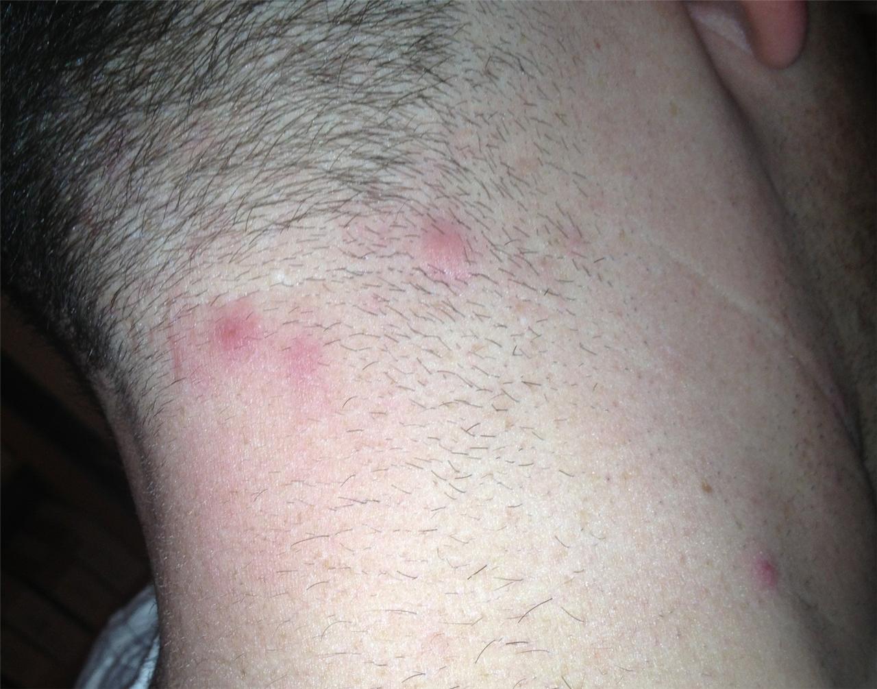 Are These Ingrowns Folliculitis Pseudo Folliculitis Pimples